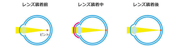 オルソケラトロジーのしくみ